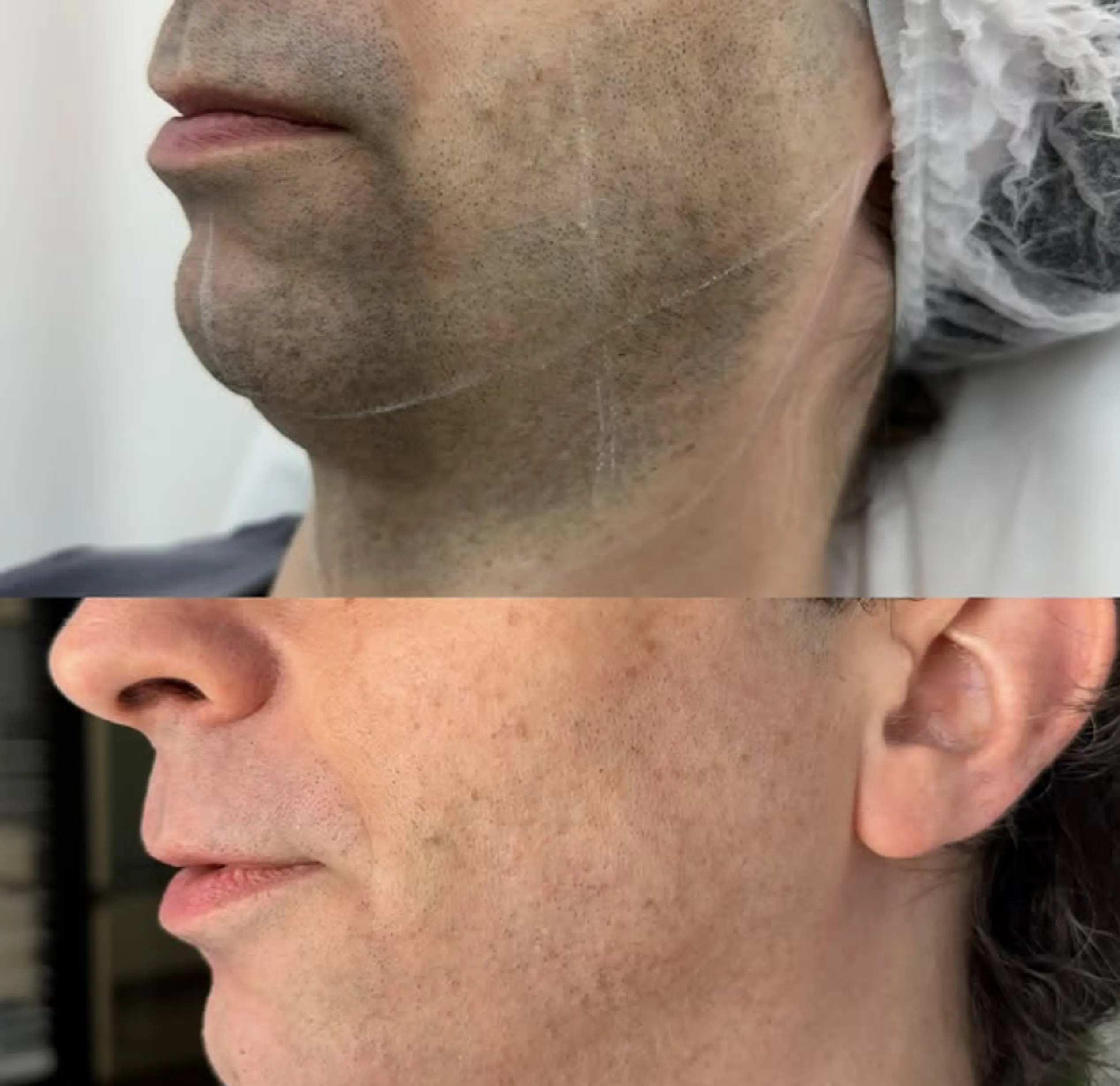 advanced laser training beauty industry