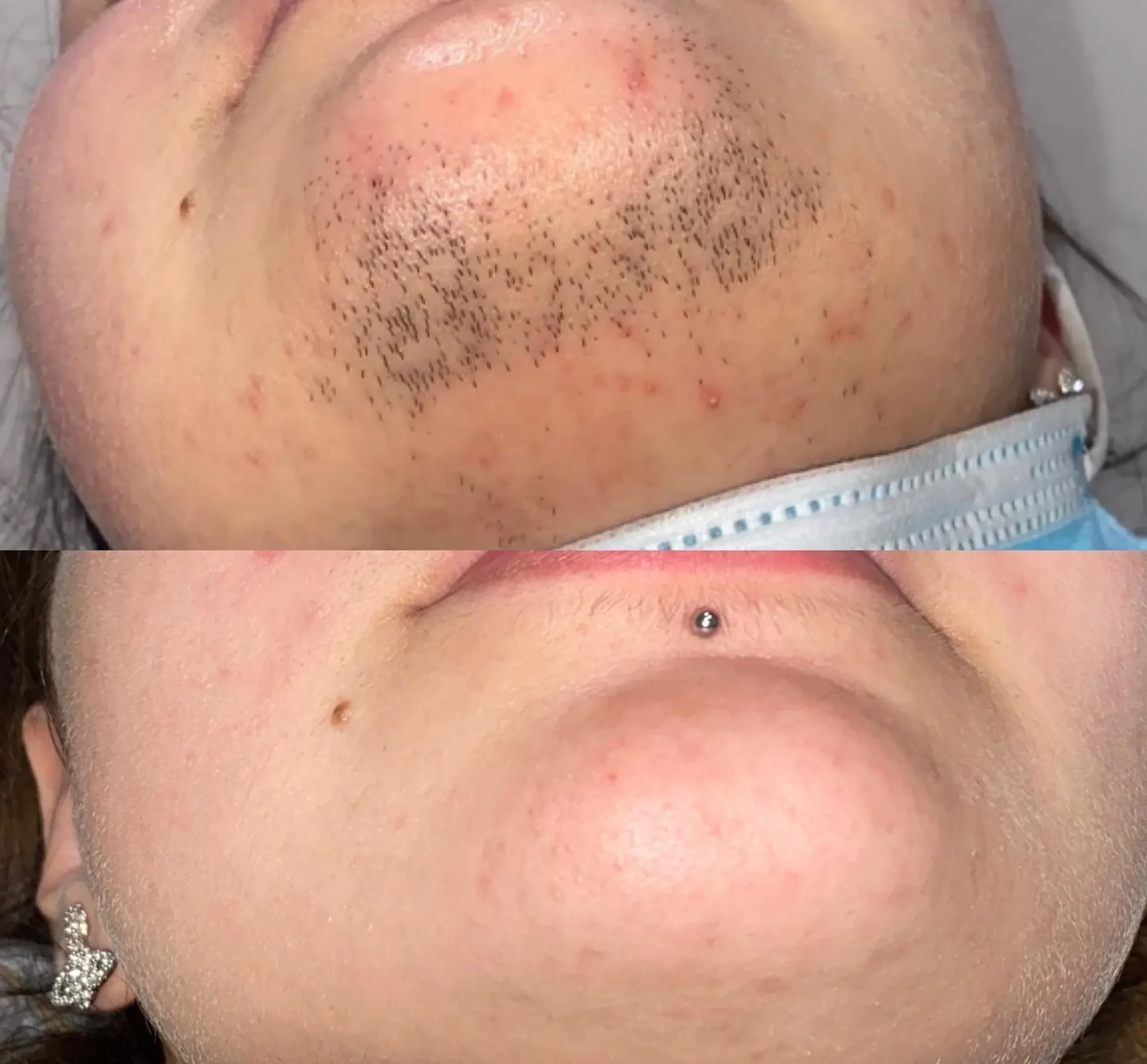 IPL laser training course