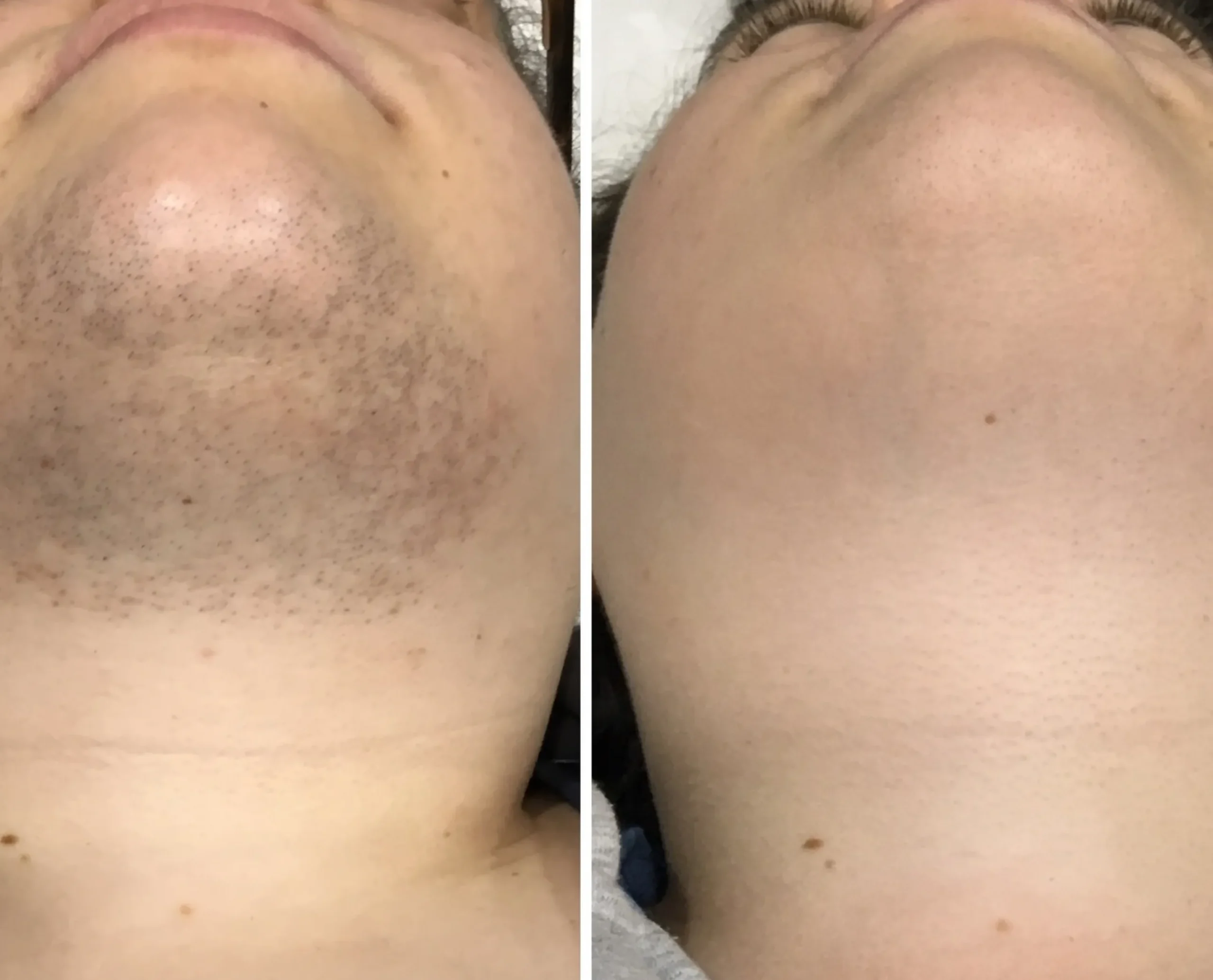 laser hair removal certification